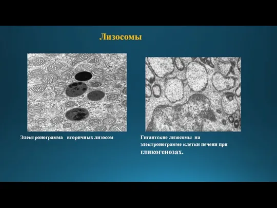 Лизосомы Электронограмма вторичных лизосом Гигантские лизосомы на электронограмме клетки печени при гликогенозах.