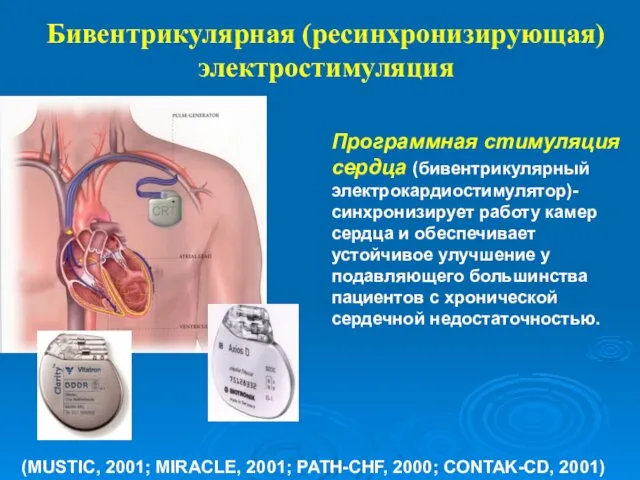 Бивентрикулярная (ресинхронизирующая) электростимуляция (MUSTIC, 2001; MIRACLE, 2001; PATH-CHF, 2000; CONTAK-CD,