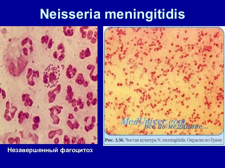 Neisseria meningitidis Незавершенный фагоцитоз