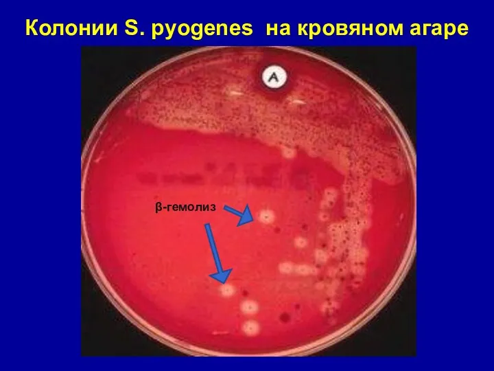 Колонии S. pyogenes на кровяном агаре β-гемолиз