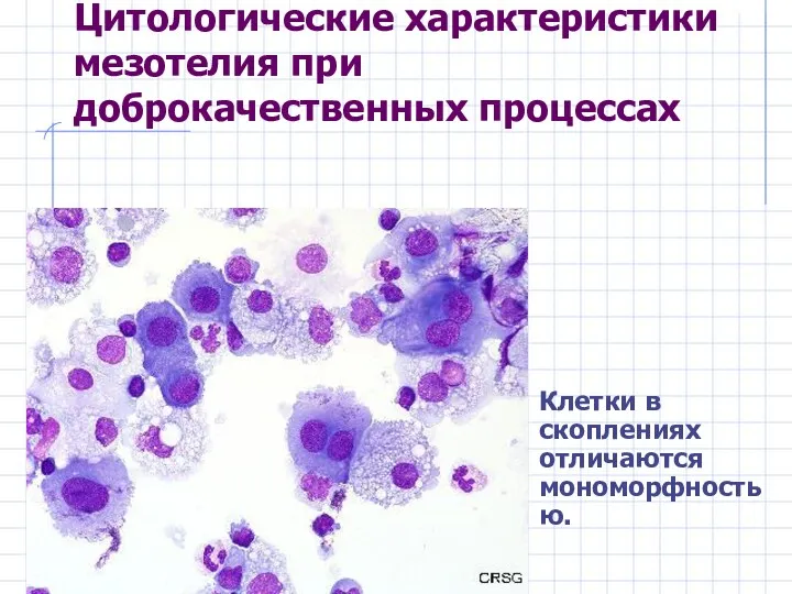 Цитологические характеристики мезотелия при доброкачественных процессах Клетки в скоплениях отличаются мономорфностью.