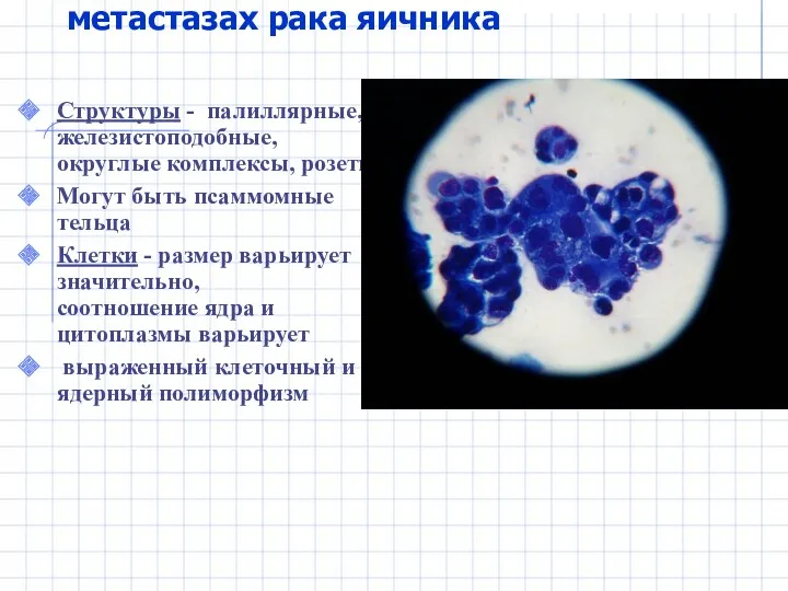 Цитограмма экссудата при метастазах рака яичника Структуры - палиллярные, железистоподобные,