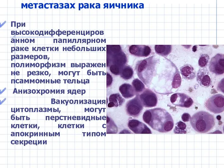 Цитограмма экссудата при метастазах рака яичника При высокодифференцированном папиллярном раке