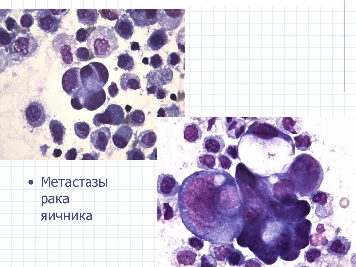 Метастазы рака яичника