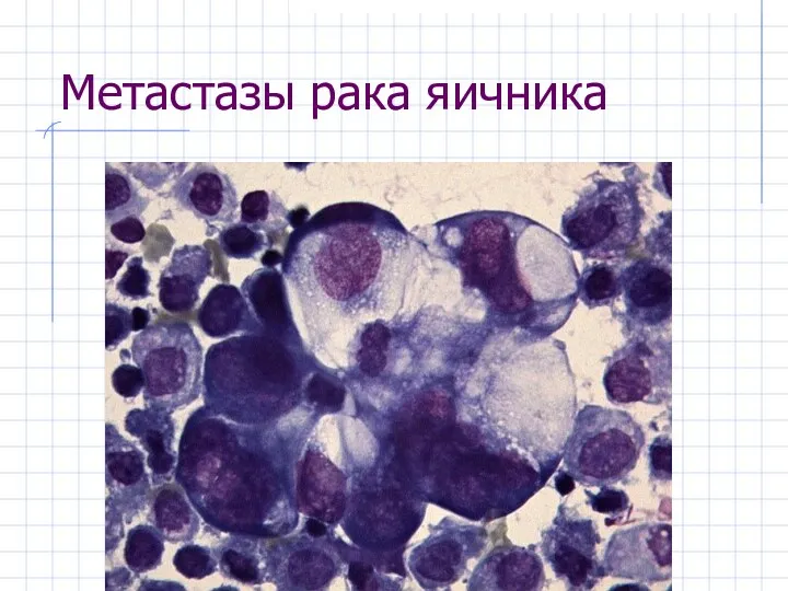 Метастазы рака яичника
