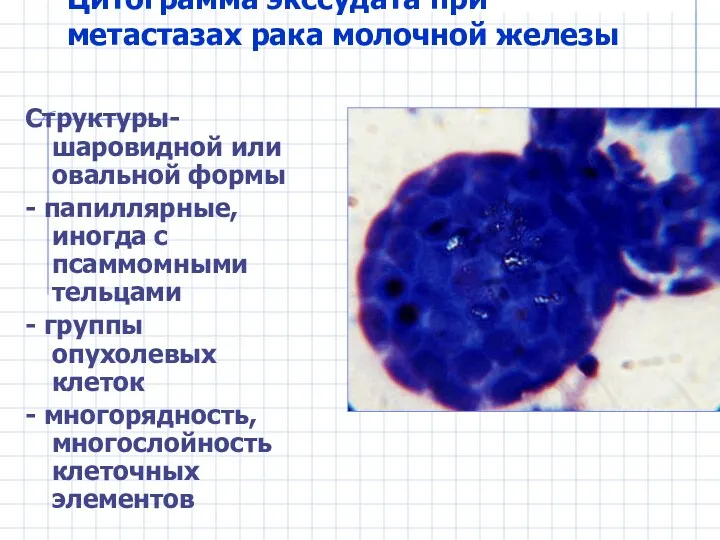 Цитограмма экссудата при метастазах рака молочной железы Структуры- шаровидной или