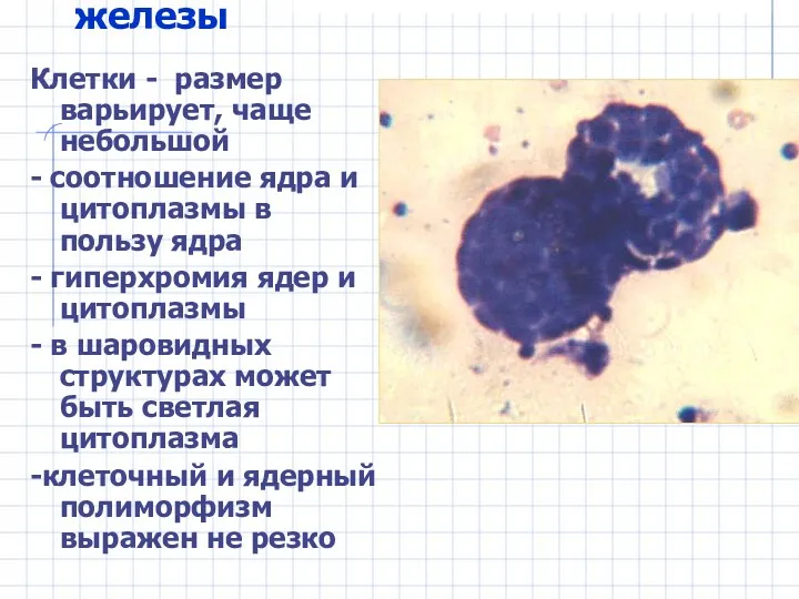 Метастазы рака молочной железы Клетки - размер варьирует, чаще небольшой