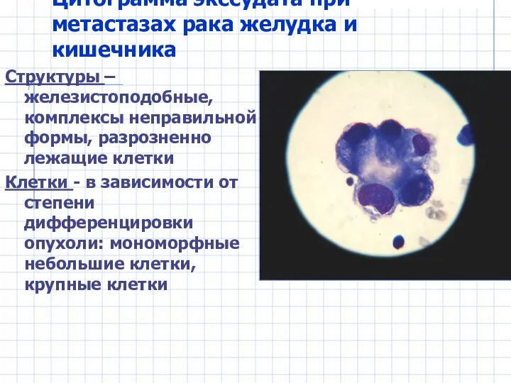 Цитограмма экссудата при метастазах рака желудка и кишечника Структуры –