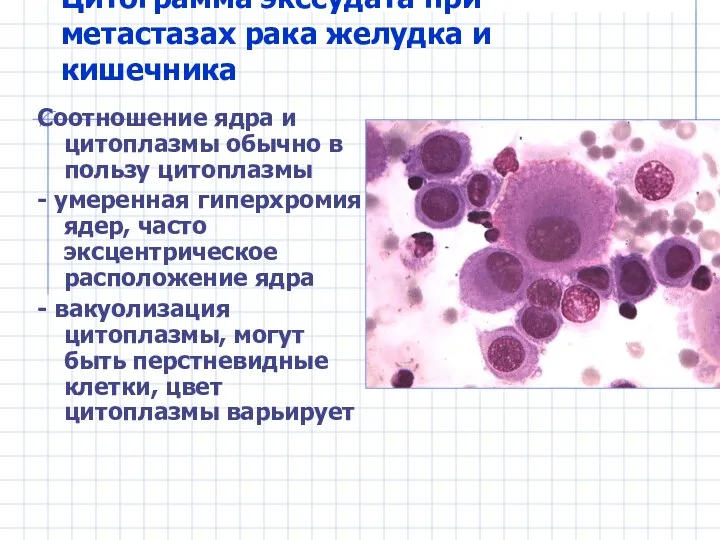 Цитограмма экссудата при метастазах рака желудка и кишечника Соотношение ядра