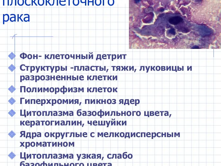 Метастазы плоскоклеточного рака Фон- клеточный детрит Структуры -пласты, тяжи, луковицы