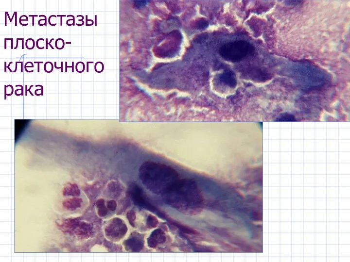 Метастазы плоско-клеточного рака