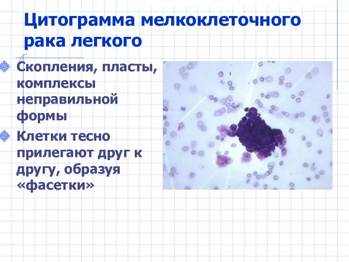 Цитограмма мелкоклеточного рака легкого Скопления, пласты, комплексы неправильной формы Клетки