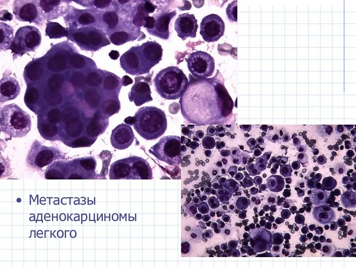 Метастазы аденокарциномы легкого