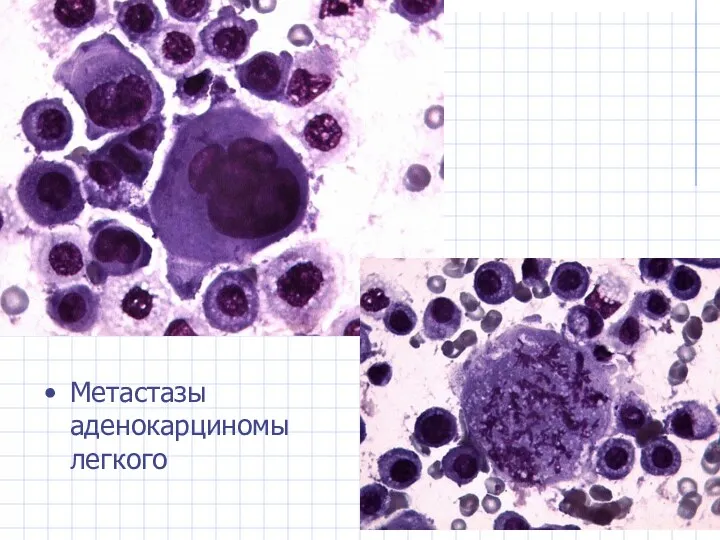 Метастазы аденокарциномы легкого