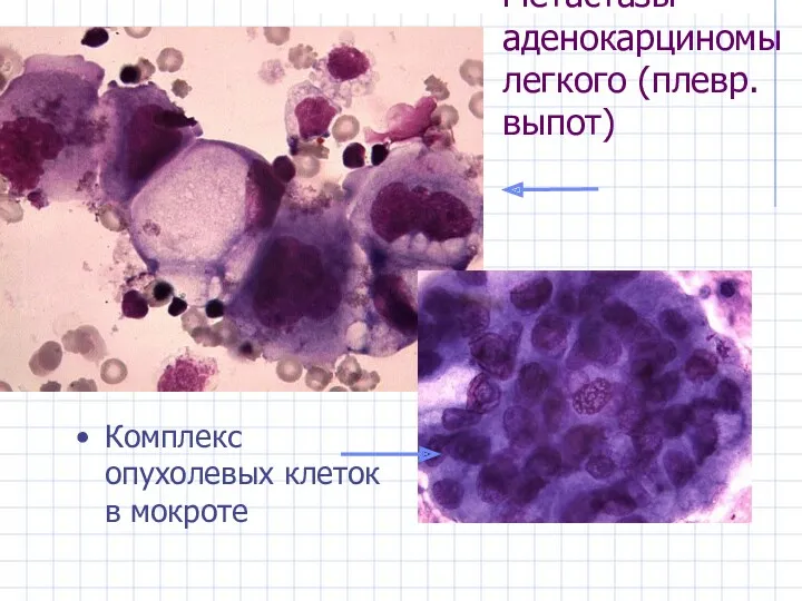 Метастазы аденокарциномы легкого (плевр. выпот) Комплекс опухолевых клеток в мокроте