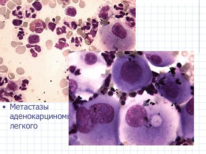 Метастазы аденокарциномы легкого