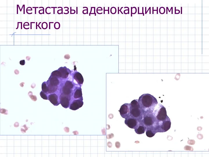 Метастазы аденокарциномы легкого