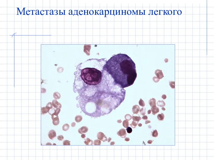 Метастазы аденокарциномы легкого