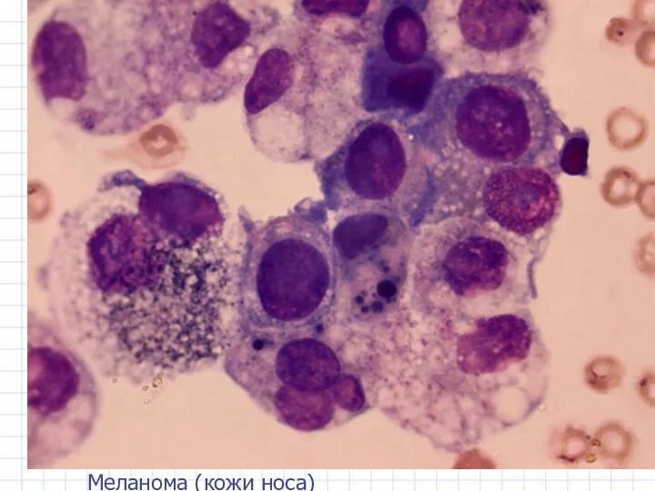 Меланома (кожи носа) Меланома (кожи носа)
