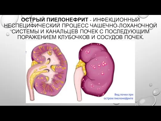 ОСТРЫЙ ПИЕЛОНЕФРИТ - ИНФЕКЦИОННЫЙ НЕСПЕЦИФИЧЕСКИЙ ПРОЦЕСС ЧАШЕЧНО-ЛОХАНОЧНОЙ СИСТЕМЫ И КАНАЛЬЦЕВ