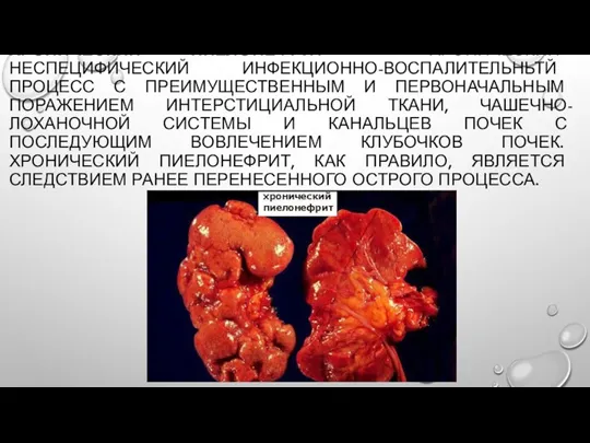 ХРОНИЧЕСКИЙ ПИЕЛОНЕФРИТ - ХРОНИЧЕСКИЙ НЕСПЕЦИФИЧЕСКИЙ ИНФЕКЦИОННО-ВОСПАЛИТЕЛЬНЬТЙ ПРОЦЕСС С ПРЕИМУЩЕСТВЕННЫМ И