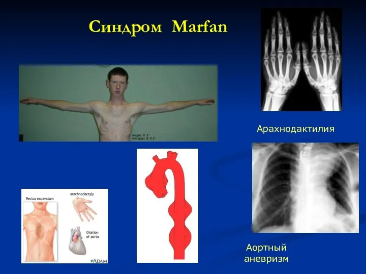 Синдром Marfan
