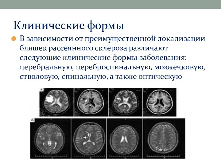 Клинические формы В зависимости от преимущественной локализации бляшек рассеянного склероза