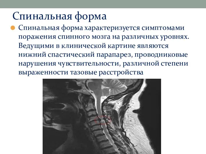 Спинальная форма Спинальная форма характеризуется симптомами поражения спинного мозга на