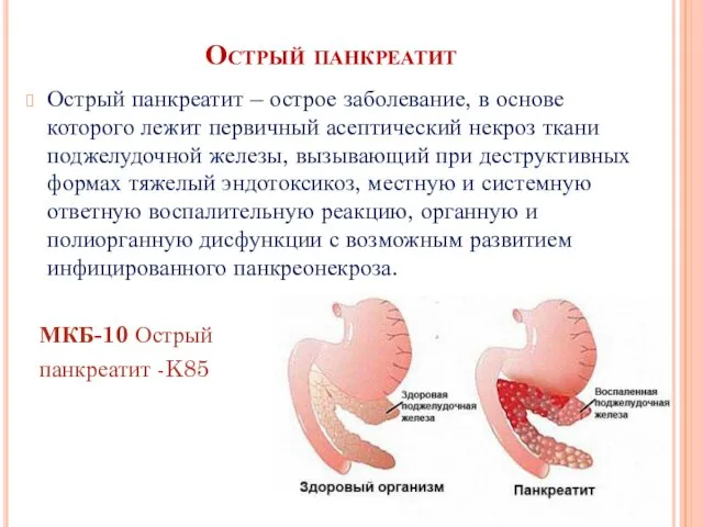 Острый панкреатит Острый панкреатит – острое заболевание, в основе которого