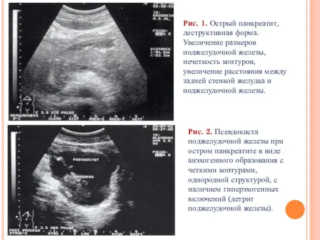 Рис. 1. Острый панкреатит, деструктивная форма. Увеличение размеров поджелудочной железы, нечеткость контуров, увеличение