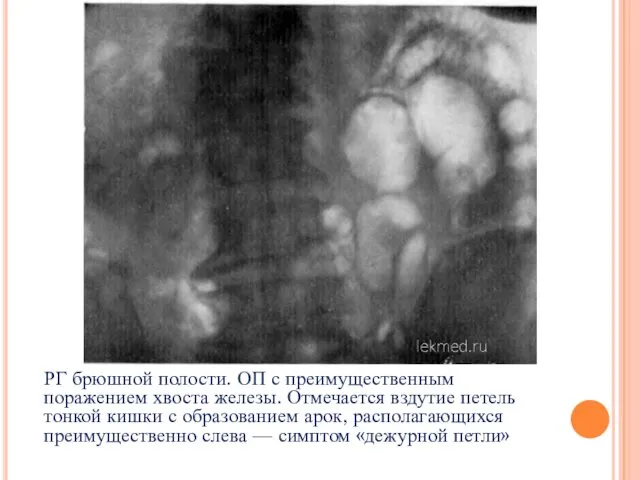 РГ брюшной полости. ОП с преимущественным поражением хвоста железы. Отмечается