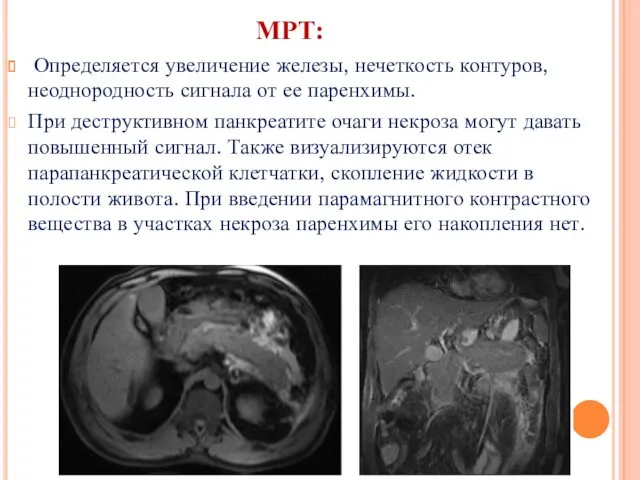МРТ: Определяется увеличение железы, нечеткость контуров, неоднородность сигнала от ее