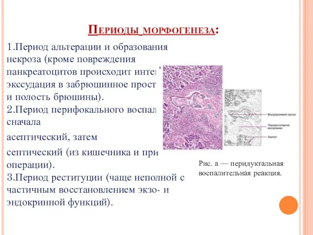 Периоды морфогенеза: 1.Период альтерации и образования некроза (кроме повреждения панкреатоцитов происходит интенсивная экссудация