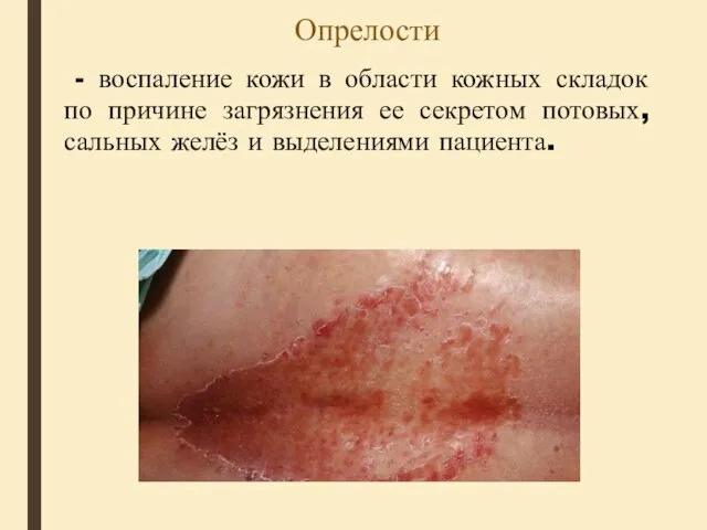 Опрелости - воспаление кожи в области кожных складок по причине загрязнения ее секретом