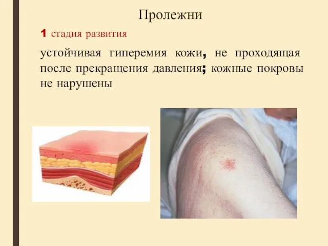 Пролежни 1 стадия развития устойчивая гиперемия кожи, не проходящая после прекращения давления; кожные покровы не нарушены