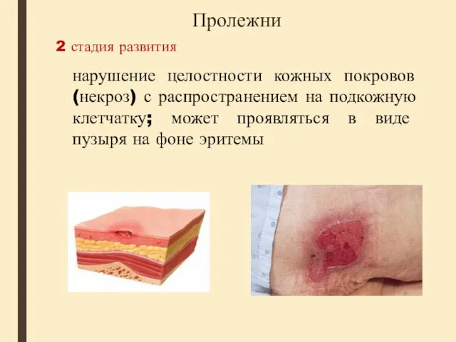 Пролежни 2 стадия развития нарушение целостности кожных покровов (некроз) с распространением на подкожную