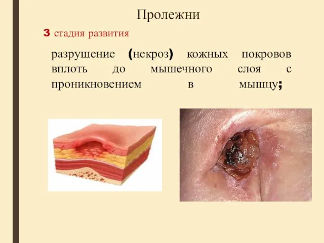 Пролежни 3 стадия развития разрушение (некроз) кожных покровов вплоть до мышечного слоя с проникновением в мышцу;