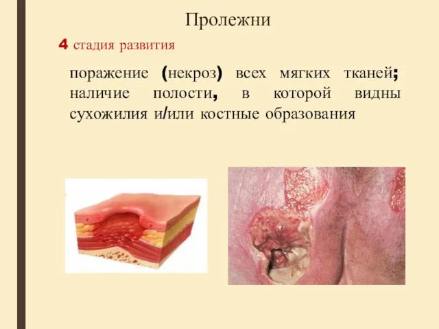 Пролежни 4 стадия развития поражение (некроз) всех мягких тканей; наличие полости, в которой