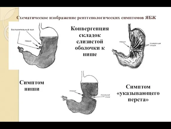 Схематическое изображение рентгенологических симптомов ЯБЖ Симптом ниши Конвергенция складок слизистой оболочки к нише Симптом «указывающего перста»