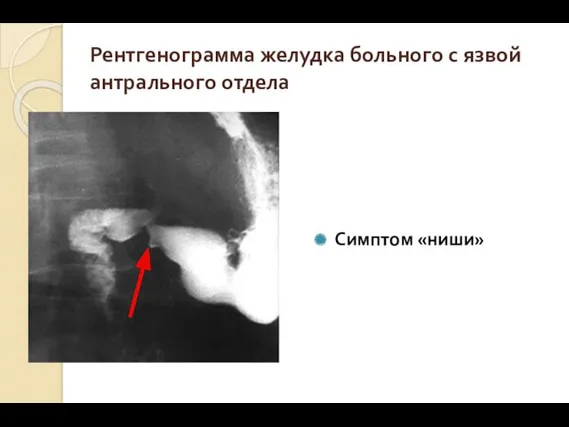 Рентгенограмма желудка больного с язвой антрального отдела Симптом «ниши»