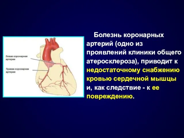 Болезнь коронарных артерий (одно из проявлений клиники общего атеросклероза), приводит к недостаточному снабжению