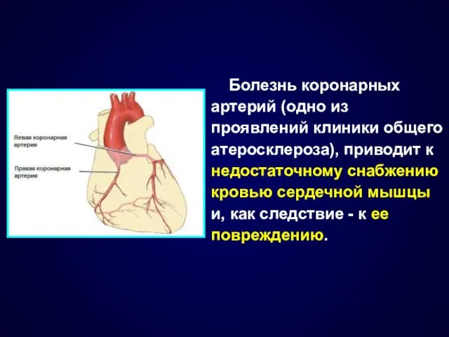 Болезнь коронарных артерий (одно из проявлений клиники общего атеросклероза), приводит