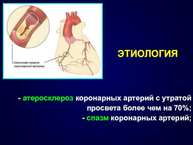 ЭТИОЛОГИЯ - атеросклероз коронарных артерий с утратой просвета более чем на 70%; - спазм коронарных артерий;