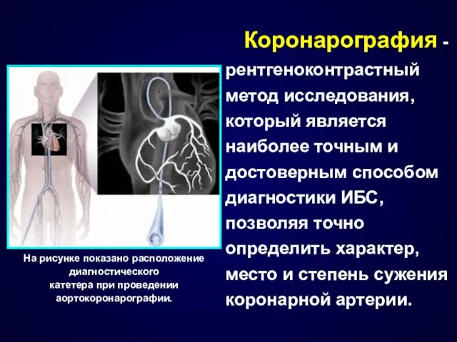 Коронарография - рентгеноконтрастный метод исследования, который является наиболее точным и