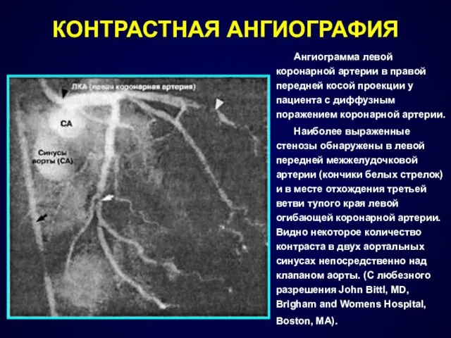 КОНТРАСТНАЯ АНГИОГРАФИЯ Ангиограмма левой коронарной артерии в правой передней косой проекции у пациента