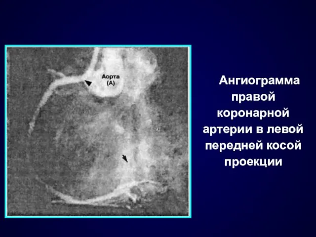 Ангиограмма правой коронарной артерии в левой передней косой проекции