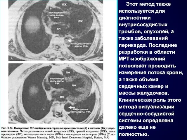 Этот метод также используется для диагностики внутрисосудистых тромбов, опухолей, а