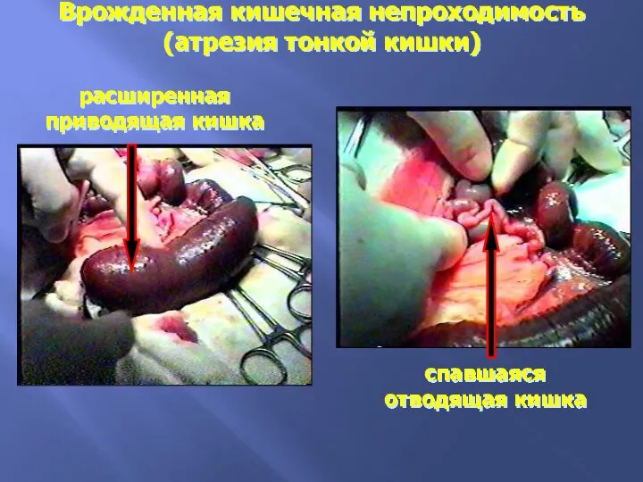 Врожденная кишечная непроходимость (атрезия тонкой кишки) расширенная приводящая кишка спавшаяся отводящая кишка