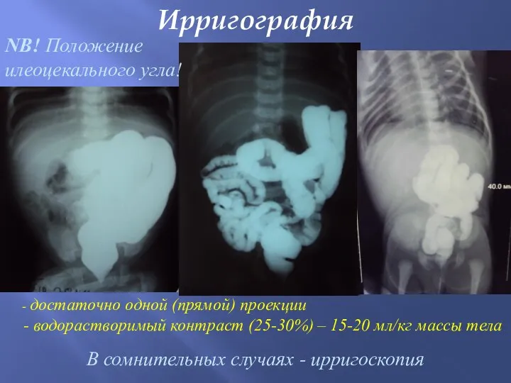 Ирригография В сомнительных случаях - ирригоскопия - достаточно одной (прямой)