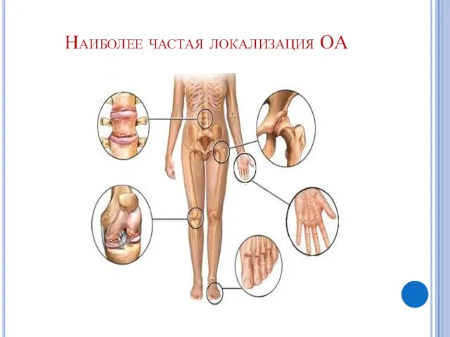 Наиболее частая локализация ОА